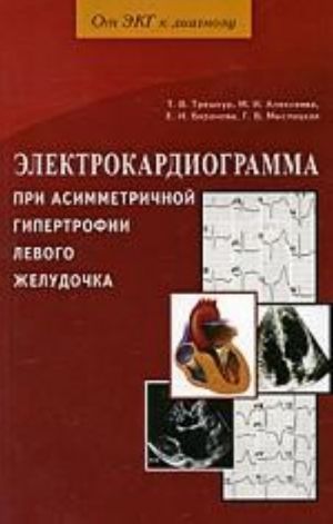 Elektrokardiogramma pri asimmetrichnoj gipertrofii levogo zheludochka