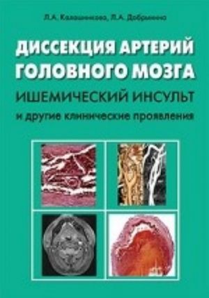 Dissektsija arterij golovnogo mozga. Ishemicheskij insult i drugie klinicheskie projavlenija