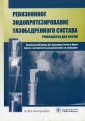 Revizionnoe endoprotezirovanie tazobedrennogo sustava