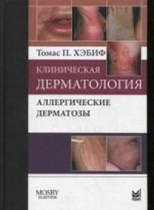 Klinicheskaja dermatologija. Allergicheskie dermatozy