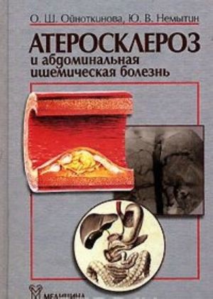 Атеросклероз и абдоминальная ишемическая болезнь