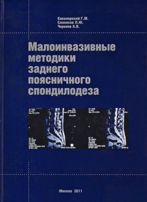 Малоинвазивные методики заднего поясничного спондилодеза