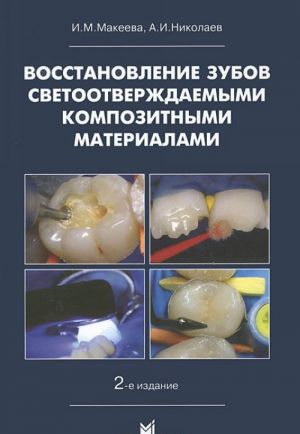 Восстановление зубов светоотверждаемыми композитными материалами