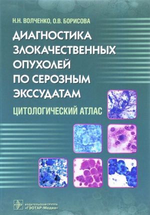 Diagnostika zlokachestvennykh opukholej po seroznym ekssudatam.