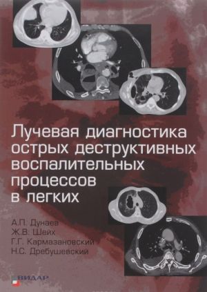 Luchevaja diagnostika ostrykh destruktivnykh vospalitelnykh protsessov v legkikh