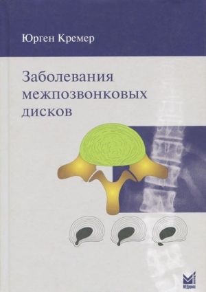 Заболевания межпозвонковых дисков