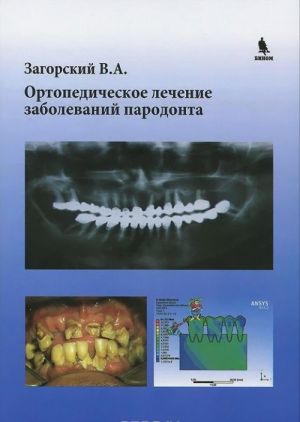 Ortopedicheskoe lechenie zabolevanij parodonta