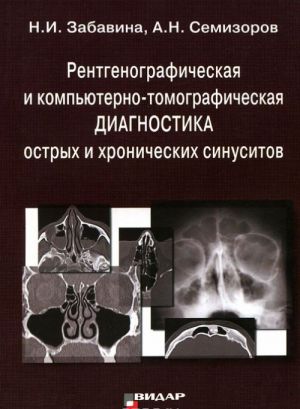 Рентгенографическая и компьютерно-томографическая диагностика острых и хронических синуситов